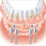 Zahnimplantat Unterkiefer
